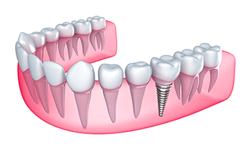 illustration of teeth and gums with dental implant Mansfield, OH