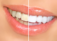teeth whitening before and after Mansfield, OH